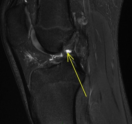 Figure 5 for case Capsular attachmet tear